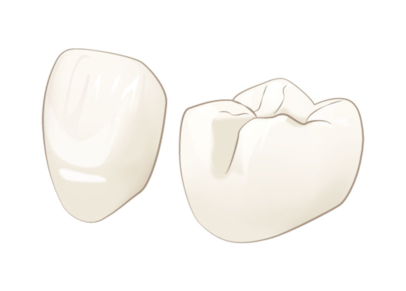 しのはら歯科医院　審美治療　イーマックス