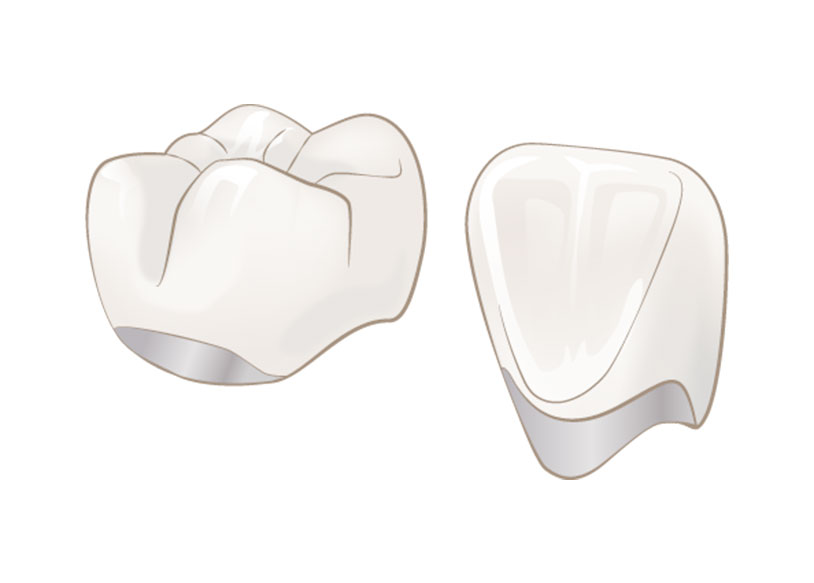 しのはら歯科医院　審美治療　メタルボンド