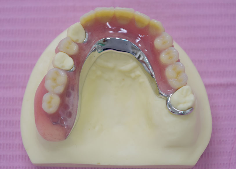 しのはら歯科医院　義歯・入れ歯　ミラクルデンチャー