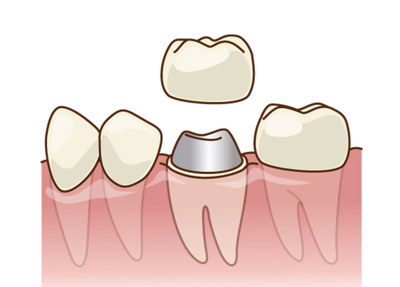 しのはら歯科医院　一般歯科　かぶせる治療