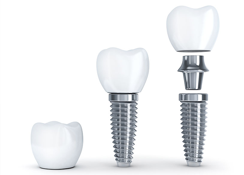 しのはら歯科医院　インプラント