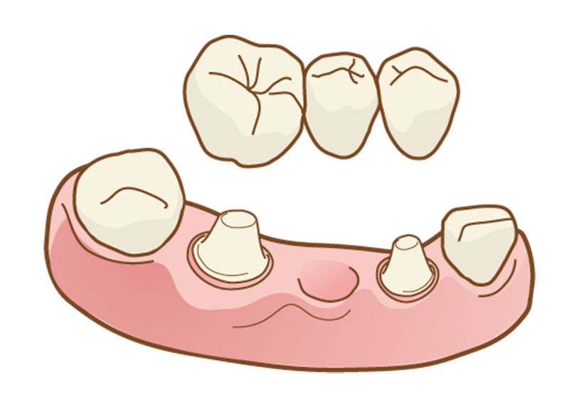 しのはら歯科医院　インプラント　ブリッジ治療の問題点