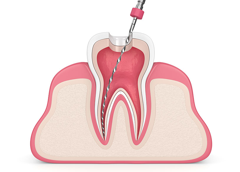 しのはら歯科医院　根管治療