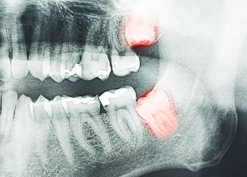しのはら歯科医院　口腔外科・親知らず　親知らずの虫歯